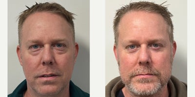 Chin Implant before and after photo