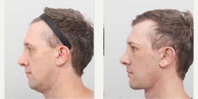 Double Eyelid Surgery before and after photo