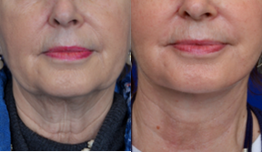 Facelift before and after photo