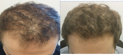 Hair Transplant before and after photo