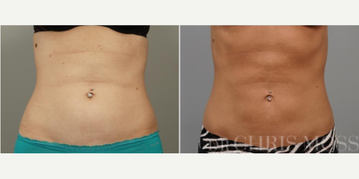 Liposuction before and after photo