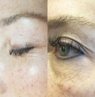 Microneedling before and after photo