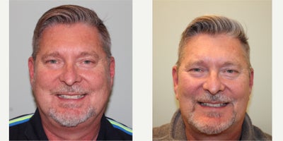 Neck Lift before and after photo