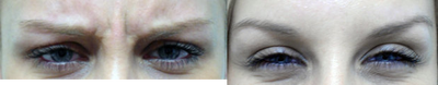 Botox before and after photo