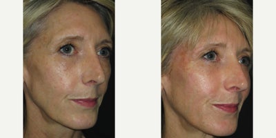 Dermal Fillers before and after photo