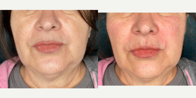 Dermal Fillers before and after photo