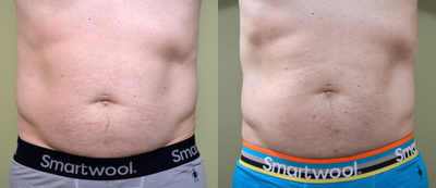 Emsculpt before and after photo