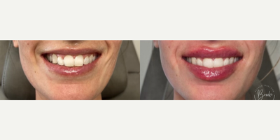 Lip Fillers before and after photo