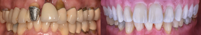 All-on-4 Dental Implants before and after photo