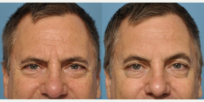 Botox before and after photo