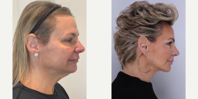 CO2 Laser before and after photo