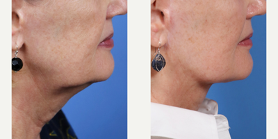 Neck Lift before and after photo
