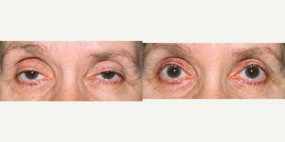 Ptosis Surgery before and after photo