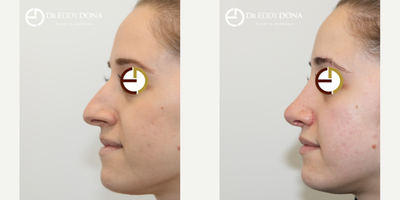 Rhinoplasty before and after photo