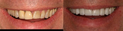 Smile Makeover before and after photo