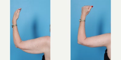 Arm Lift before and after photo