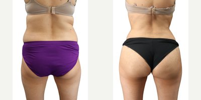 Brazilian Butt Lift before and after photo