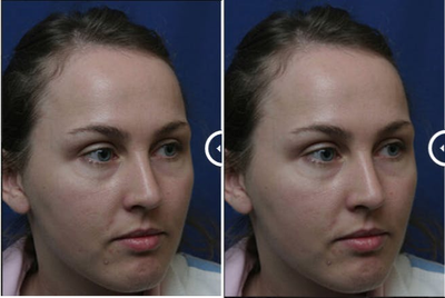 Brow Lift before and after photo