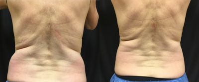 CoolSculpting before and after photo