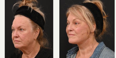 Eyelid Surgery before and after photo