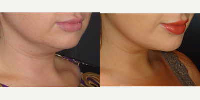 Kybella before and after photo