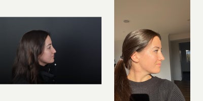 Revision Rhinoplasty before and after photo