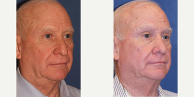 Rhinoplasty before and after photo