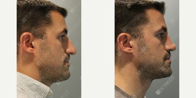 Rhinoplasty before and after photo