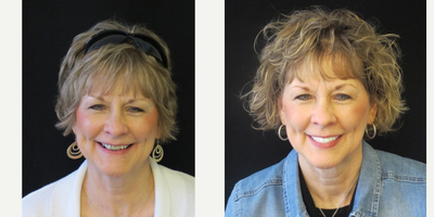 All-on-4 Dental Implants before and after photo