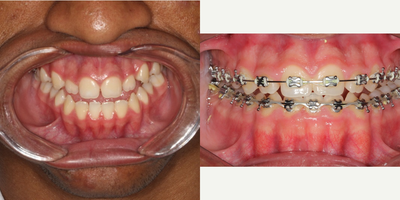 Braces before and after photo