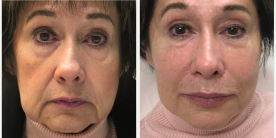 Juvederm before and after photo