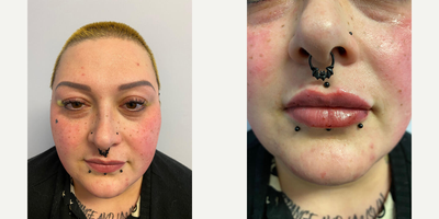 Lip Fillers before and after photo