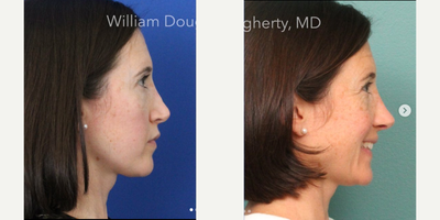 Revision Rhinoplasty before and after photo