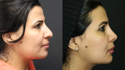 Rhinoplasty before and after photo