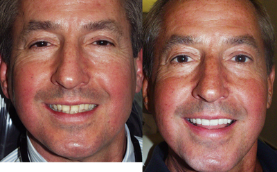 Smile Makeover before and after photo