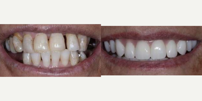 All-on-4 Dental Implants before and after photo