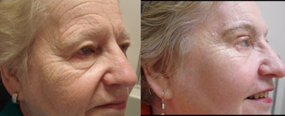CO2 Laser before and after photo
