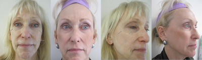 Fractional Laser before and after photo