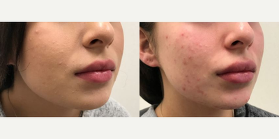 Lip Fillers before and after photo