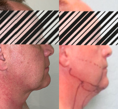 Renuvion before and after photo