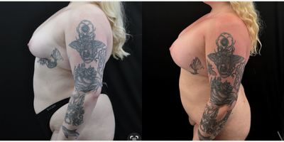 Vaser Liposuction before and after photo