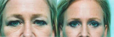 Eyelid Surgery before and after photo
