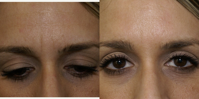 Botox before and after photo