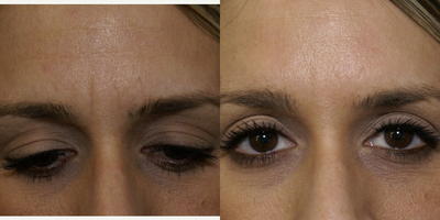 Botox before and after photo