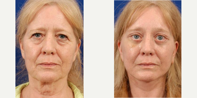 Brow Lift before and after photo