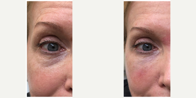 Dermal Fillers before and after photo