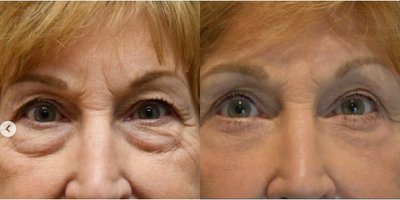 Eyelid Surgery before and after photo