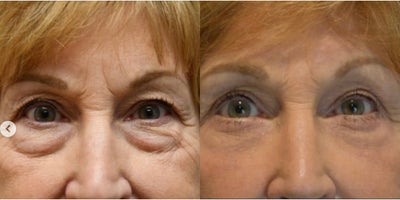 Eyelid Surgery before and after photo