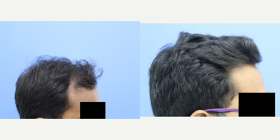 FUE Hair Transplant before and after photo