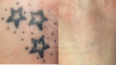 PicoSure before and after photo